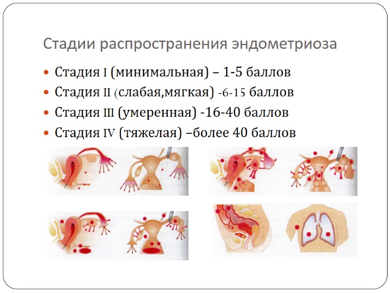 Стадии распространения эндометриоза  Стадия I (минимальная) – 1-5 баллов Стадия II (слабая,мягкая) -6-15
